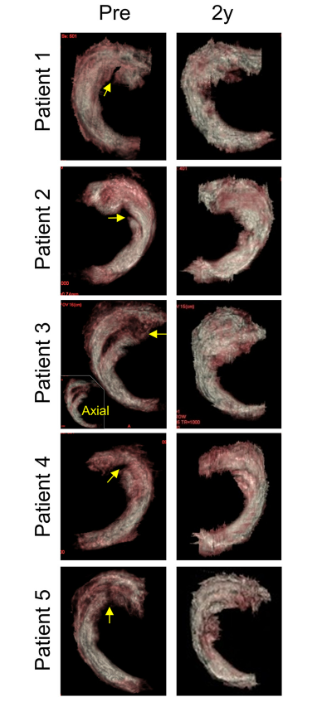 移植滑膜間充質干細胞修復前后的3D MRI圖像