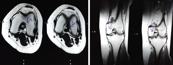 治療后MRI檢查顯示內側和外側半月板后角撕裂有所改善