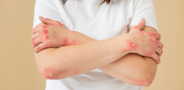 干細(xì)胞治療系統(tǒng)性紅斑狼瘡：如何實(shí)現(xiàn)從短期的疾病癥狀緩解到長期的多器官功能改善？