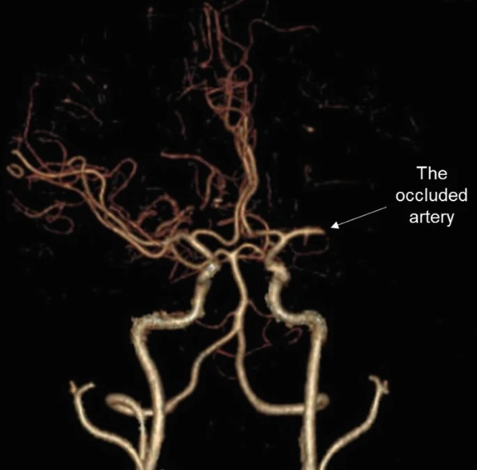 圖1：動脈閉塞導致的缺血性中風