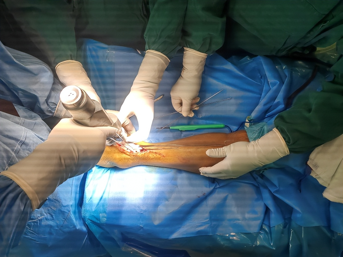 術中截骨導板輔助下精準截骨并安放假體