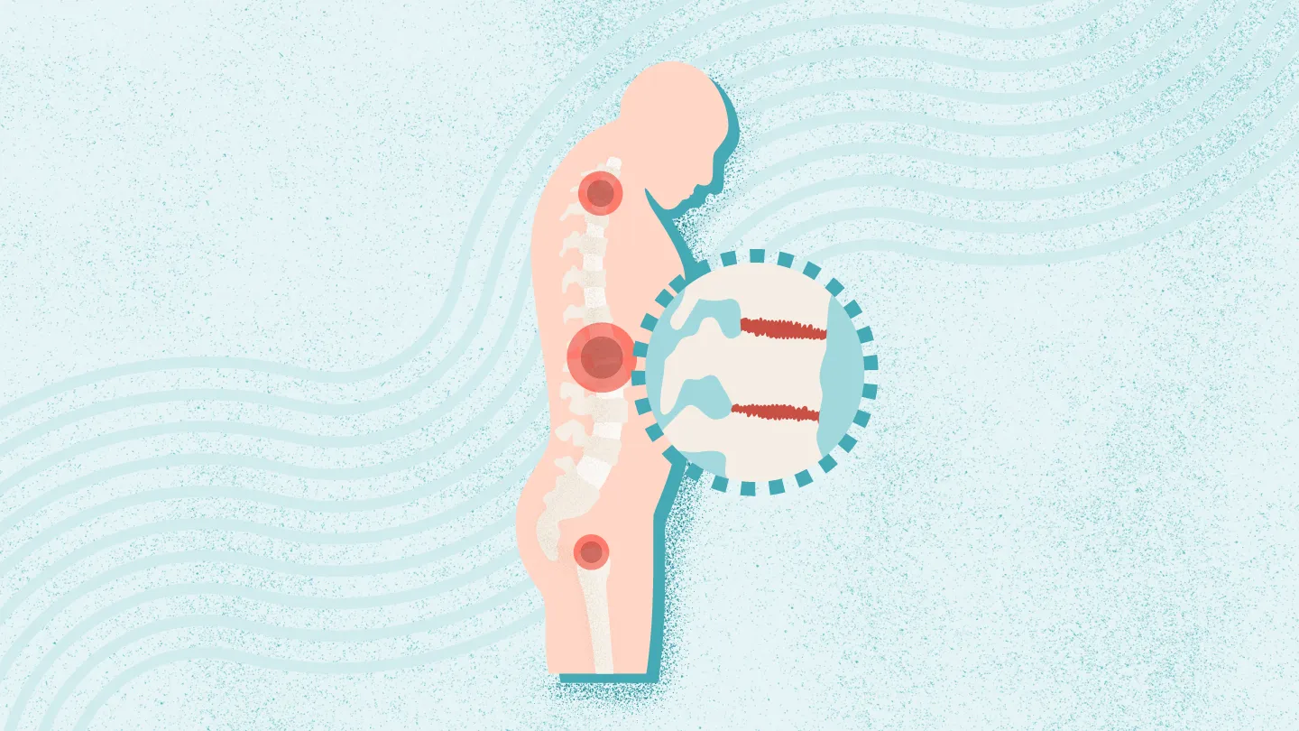 2025年干細(xì)胞治療強直性脊柱炎最新臨床進展（截至12月）