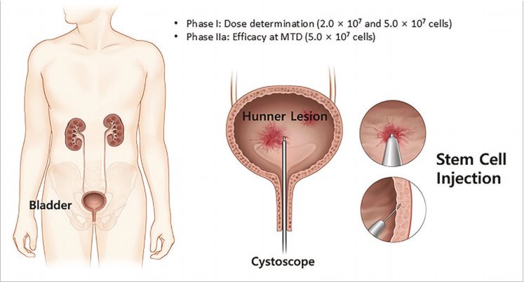 間質(zhì)性膀胱炎臨床試驗