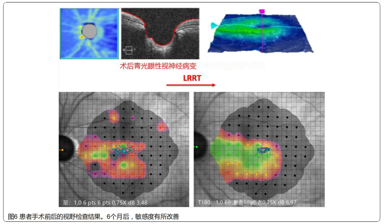 青光眼臨床試驗
