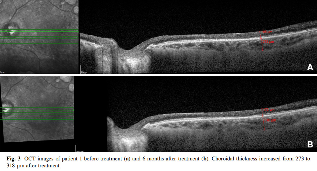 視神經萎縮臨床試驗 視神經萎縮臨床試驗
