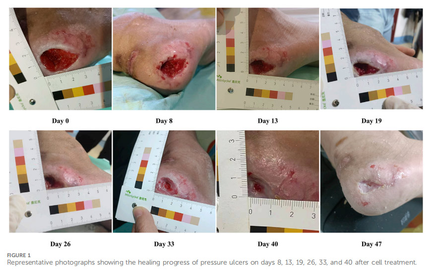 壓瘡臨床試驗(yàn)