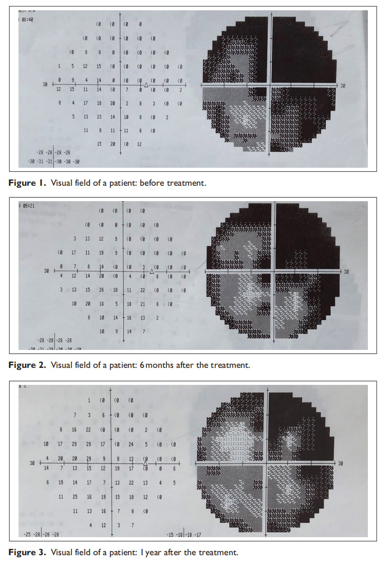 視神經(jīng)萎縮臨床試驗