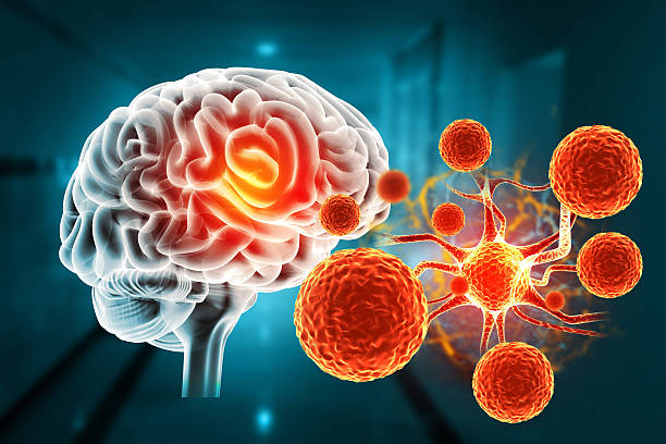 干細胞治療帕金森病取得新進展！II期臨床證實：三次輸注，安全且運動功能得到改善