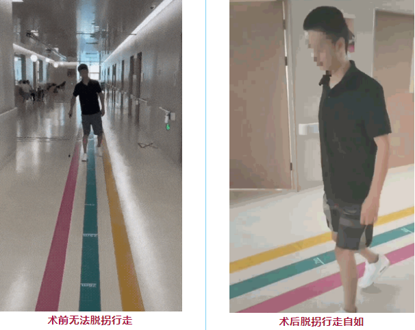 干細胞治療脊髓損傷患者