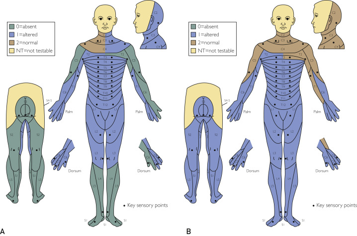 圖2：根據(jù)脊髓損傷神經(jīng)學(xué)分類國際標(biāo)準(zhǔn)，在基線（A）和 18 個月隨訪（B）時形成的皮節(jié)感覺評分。