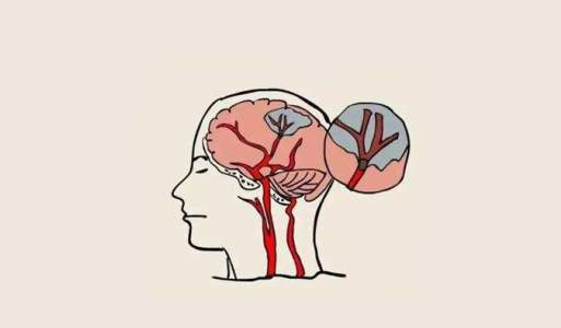 中風(fēng)后的腦損傷，真的能被干細胞療法逆轉(zhuǎn)嗎？