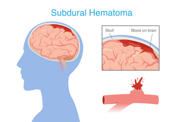 神經(jīng)干細(xì)胞移植治療腦出血的系統(tǒng)評(píng)價(jià)：NSC來(lái)源、輸送途徑、治療機(jī)制和早期臨床試驗(yàn)