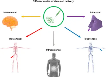 干細胞移植途徑：該圖展示了用于中風治療的干細胞輸送途徑，包括腦內（立體定向注射）、血管內（靜脈/動脈）、腹腔內、腦室內、靜脈內、鼻內和鞘內注射方法。